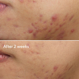 Murad Deep Relief Blemish Treatment