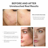 Murad Invisiscar Resurfacing Treatment