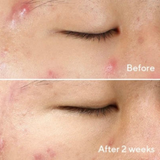 Murad Deep Relief Blemish Treatment